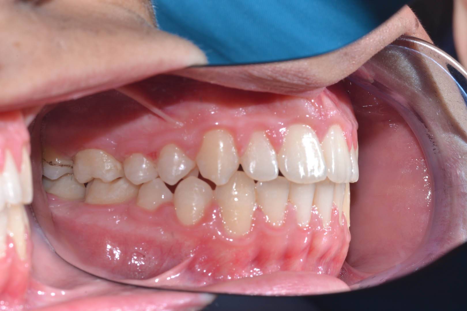 odontocentro-monza-brianza-casi-clinici-ortodonzia-fissa-20-mesi (10)