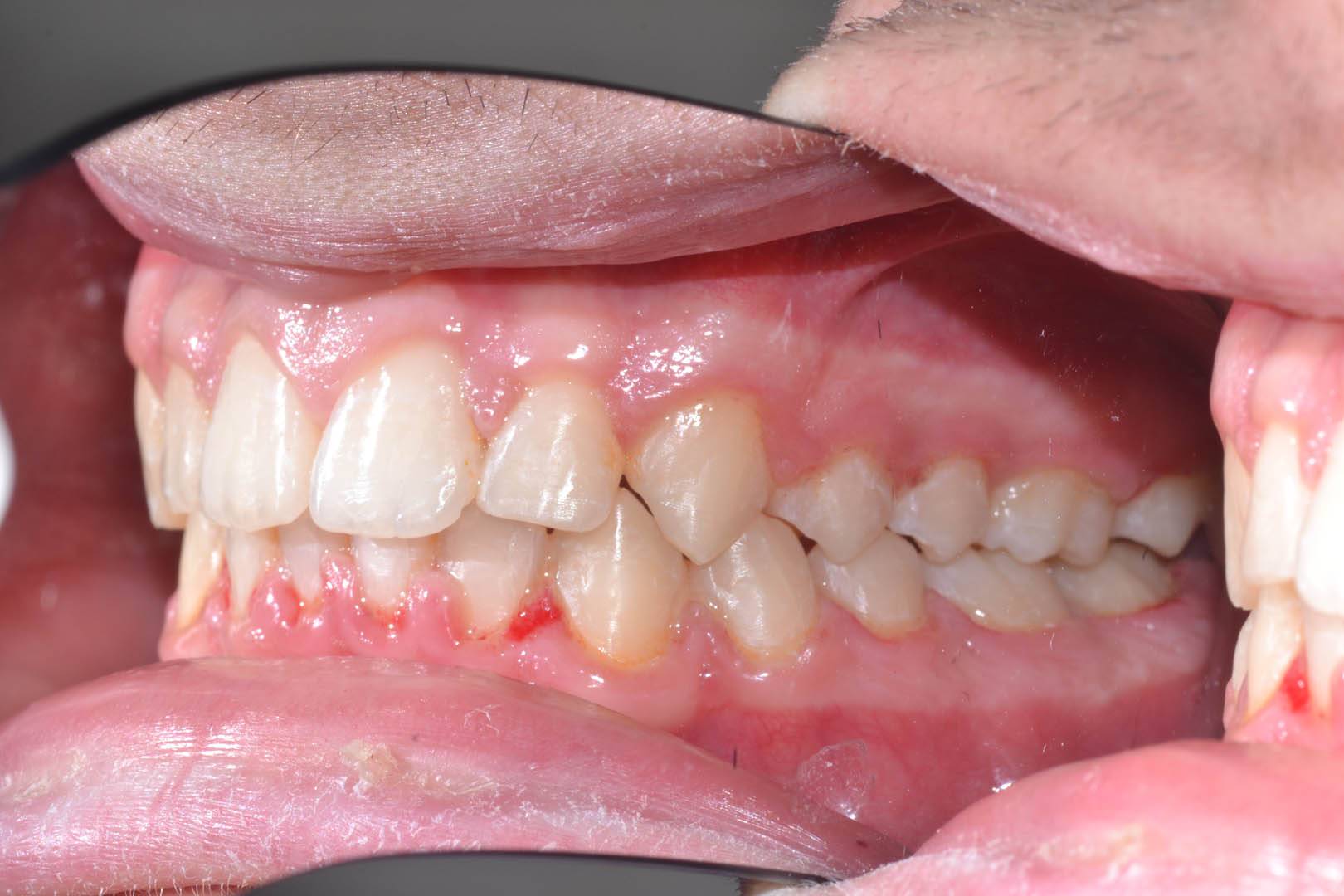 odontocentro-monza-brianza-casi-clinici-ortodonzia-bimascellare-20-mesi (9)