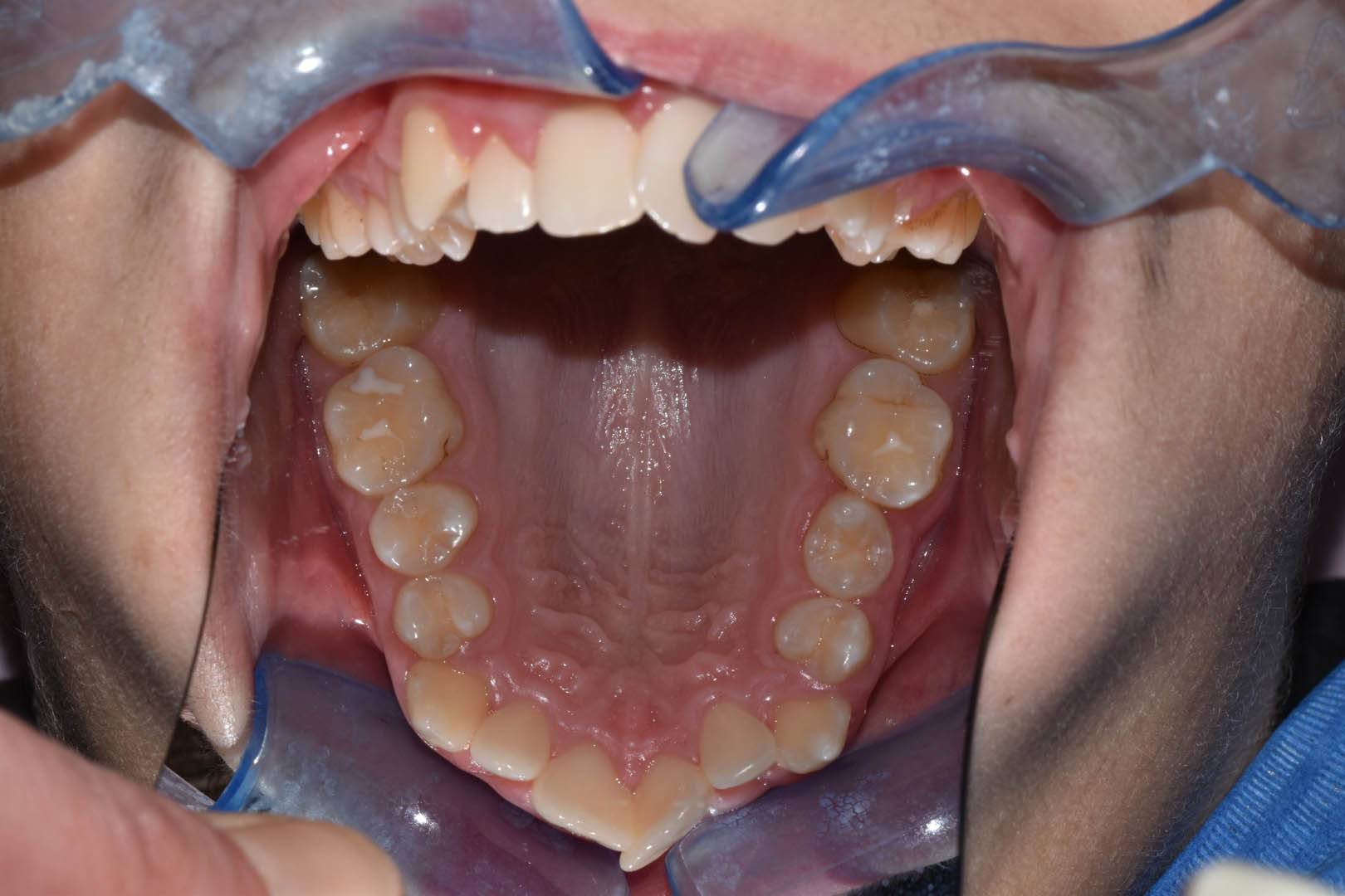 odontocentro-monza-brianza-casi-clinici-ortodonzia-fissa-20-mesi (6)