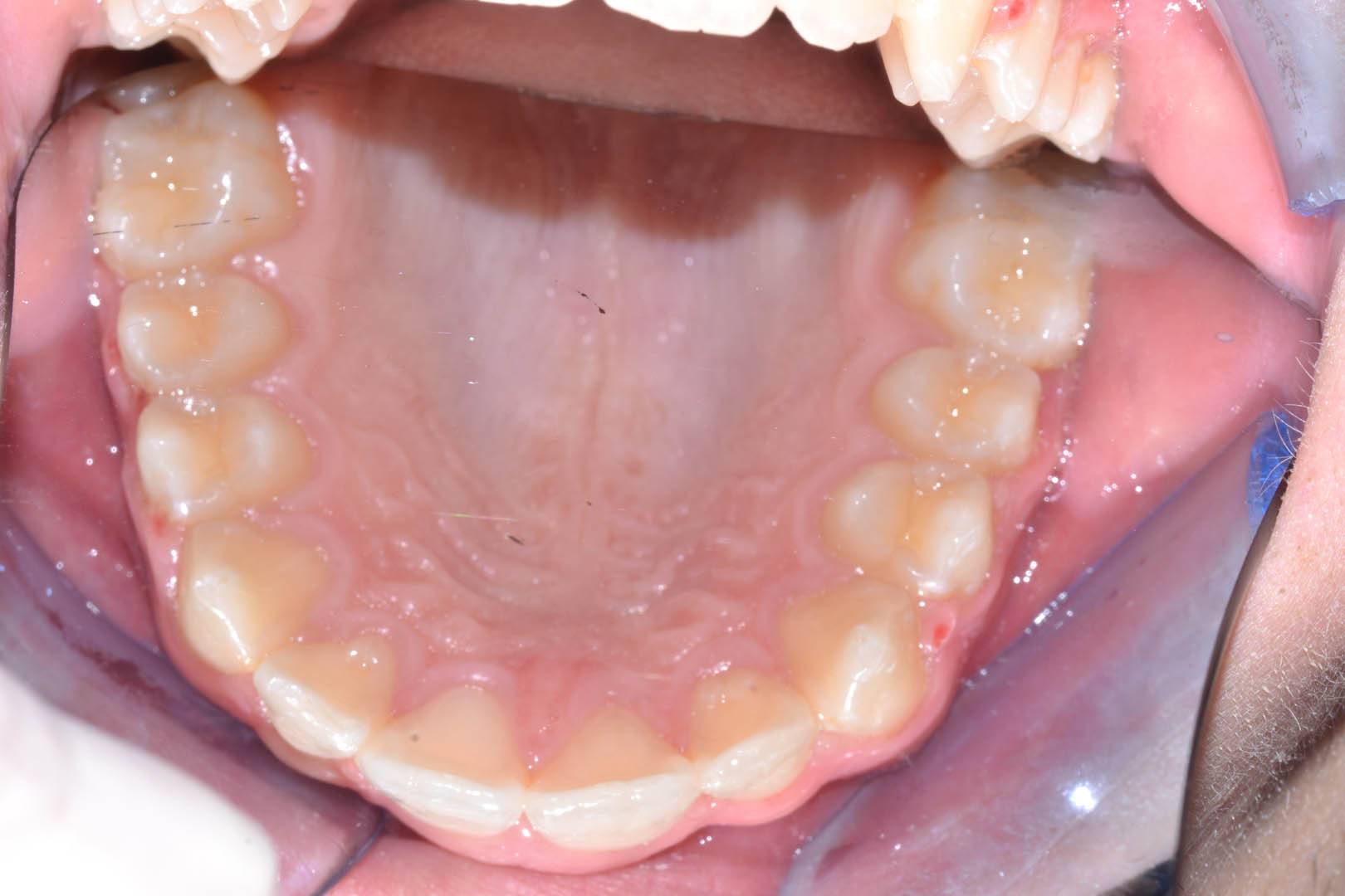 odontocentro-monza-brianza-casi-clinici-ortodonzia-bimascellare-20-mesi (11)