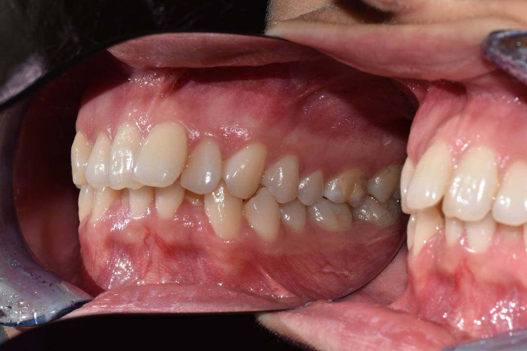 odontocentro-monza-brianza-casi-clinici-apparecchio-invisibile16-mesi (3)
