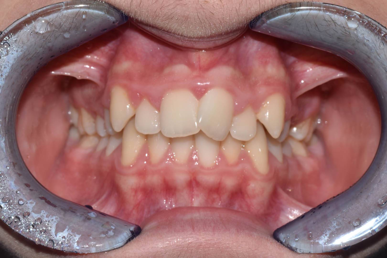 odontocentro-monza-brianza-casi-clinici-ortodonzia-fissa-20-mesi (2)
