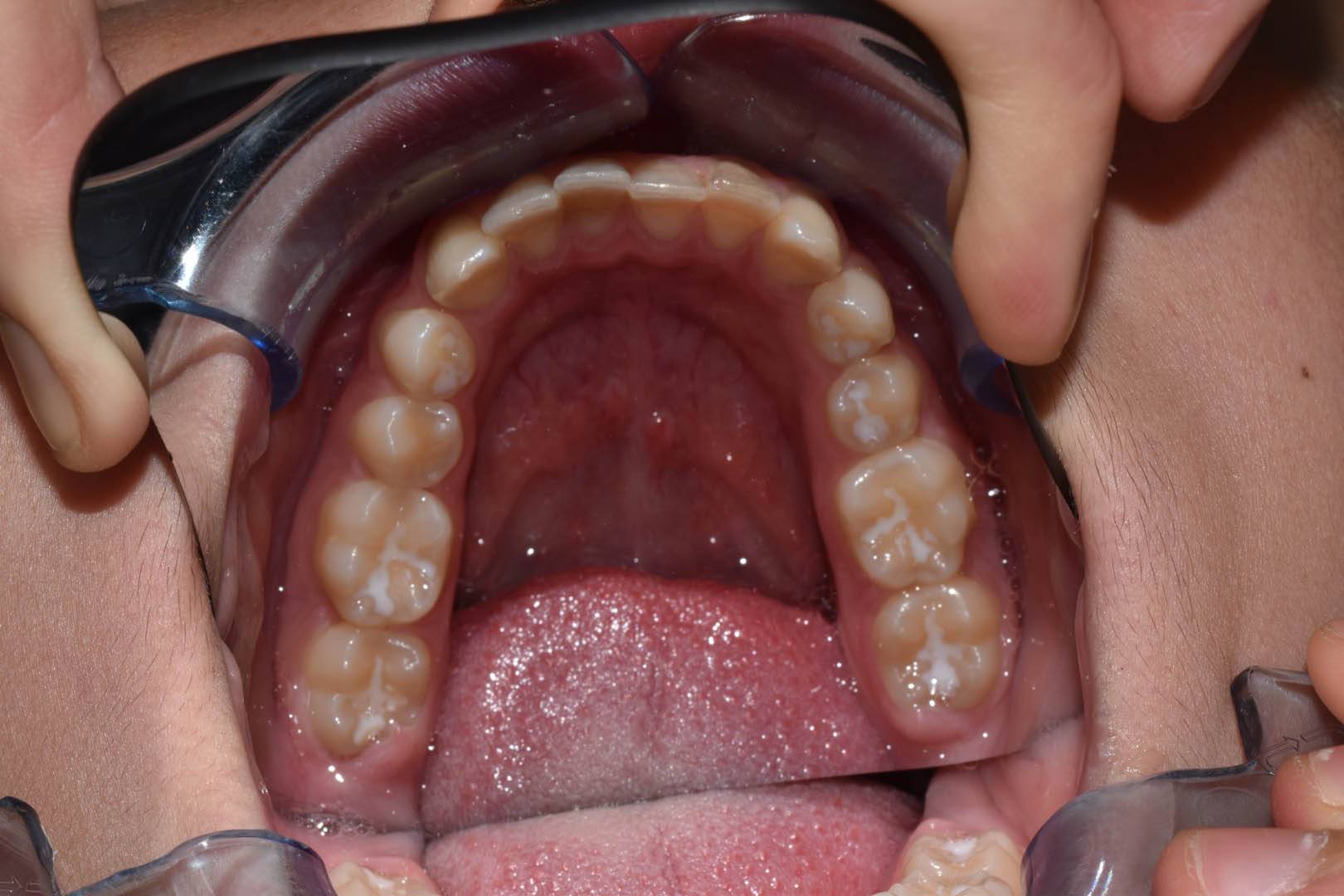 odontocentro-monza-brianza-ortodonzia-fissa- ( (5)