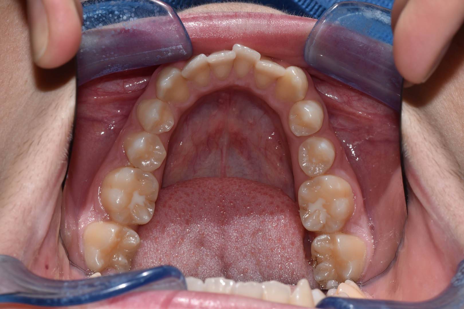 odontocentro-monza-brianza-casi-clinici-ortodonzia-fissa-20-mesi (7)