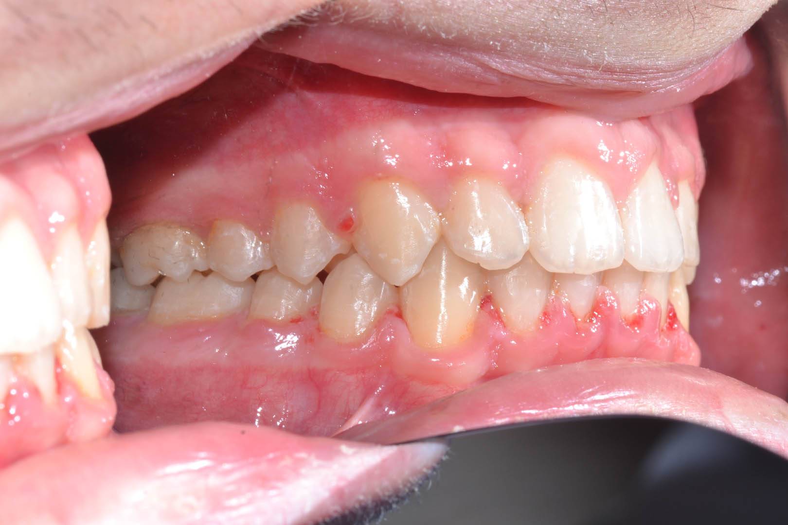 odontocentro-monza-brianza-casi-clinici-ortodonzia-bimascellare-20-mesi (10)