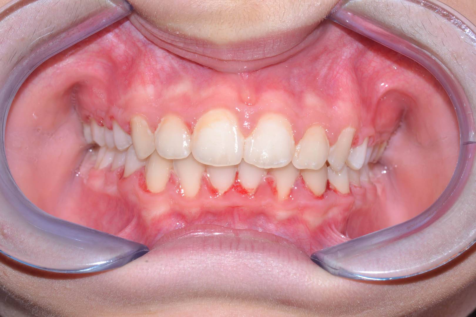 odontocentro-monza-brianza-ortodonzia-fissa- ( (6)