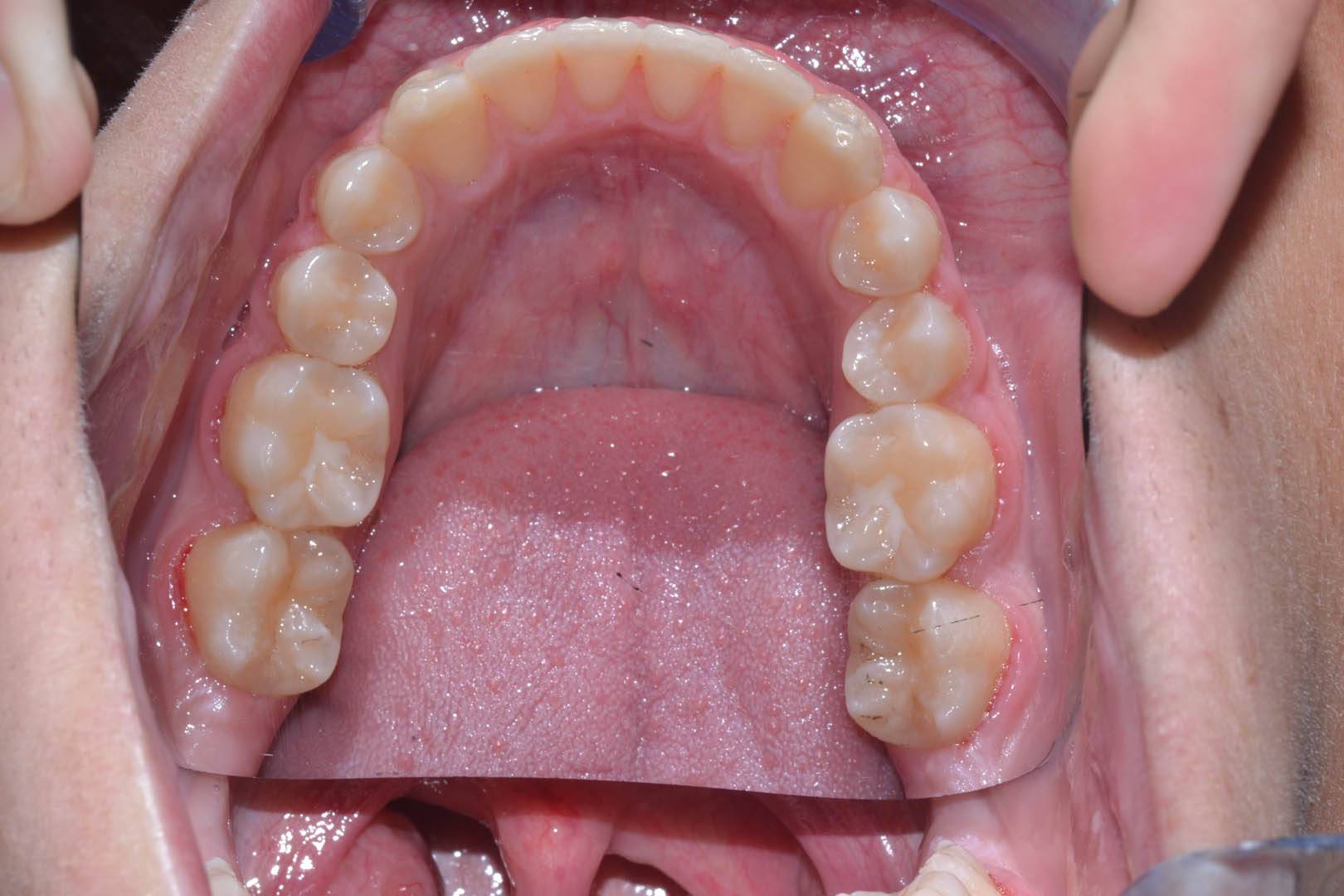 odontocentro-monza-brianza-casi-clinici-ortodonzia-fissa-20-mesi (11)