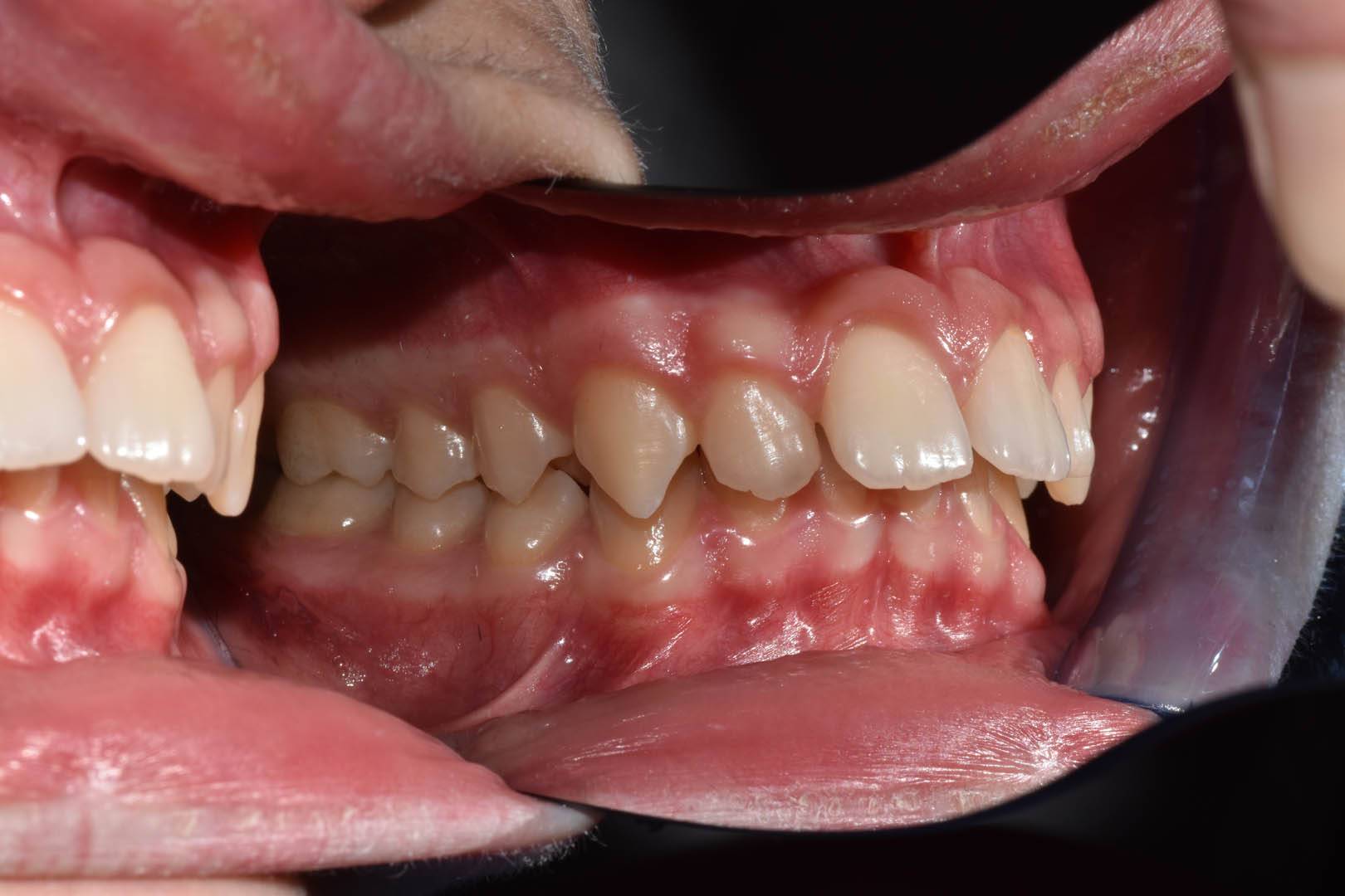 odontocentro-monza-brianza-casi-clinici-ortodonzia-bimascellare-20-mesi (4)