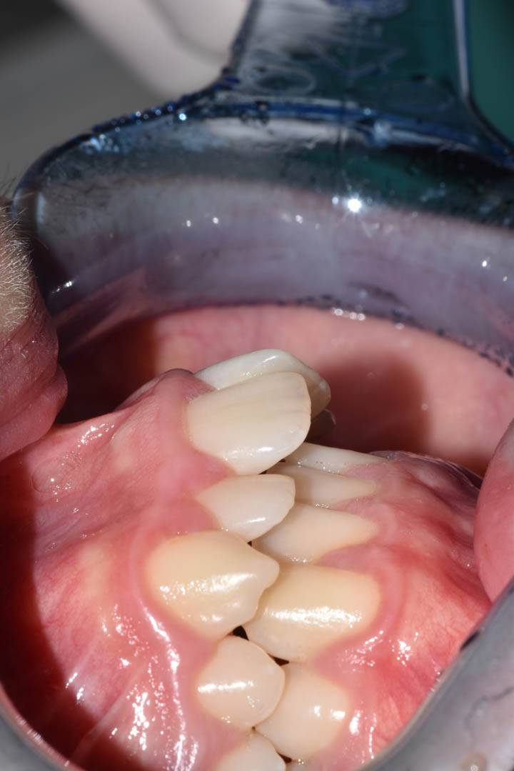 odontocentro-monza-brianza-casi-clinici-ortodonzia-fissa-20-mesi (3)