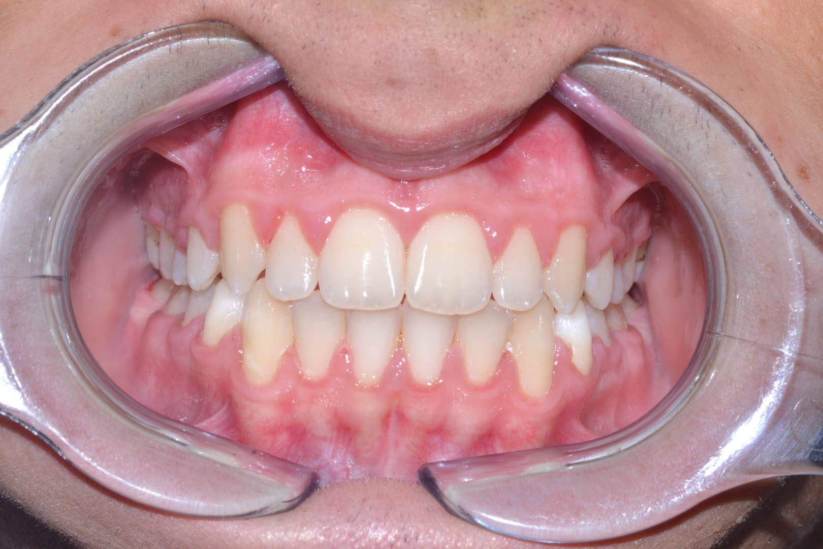 odontocentro-monza-brianza-casi-clinici-ortodonzia-fissa-20-mesi (8)
