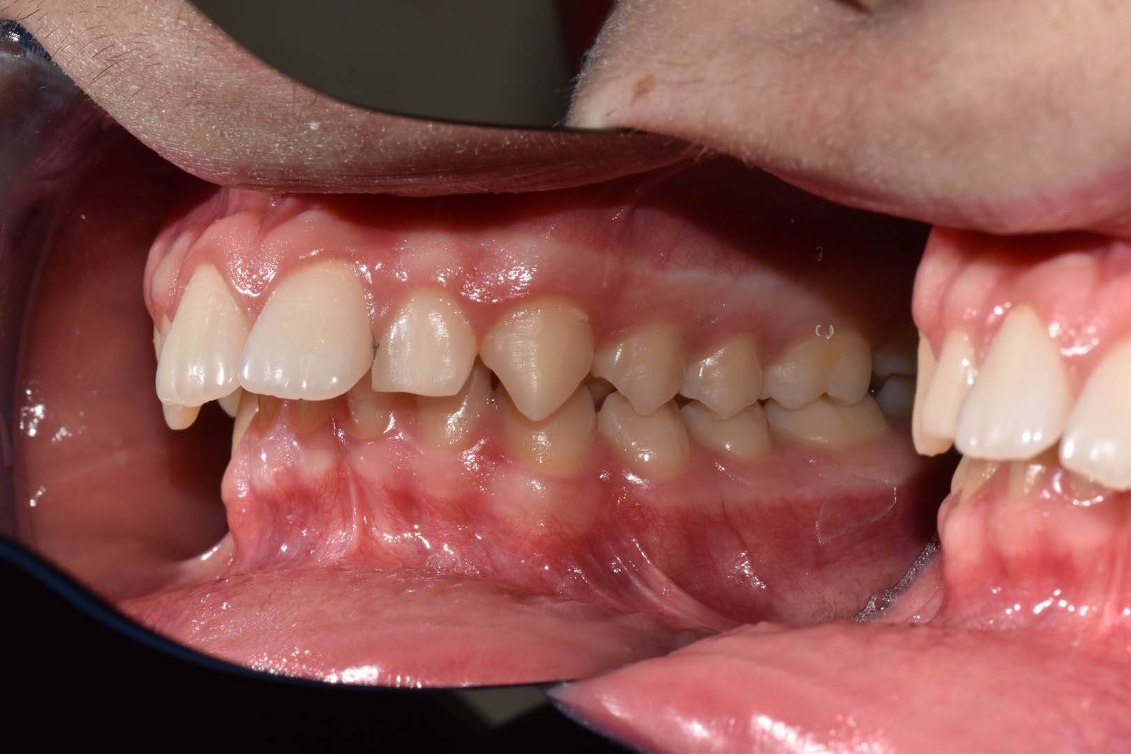 odontocentro-monza-brianza-casi-clinici-ortodonzia-bimascellare-20-mesi (3)