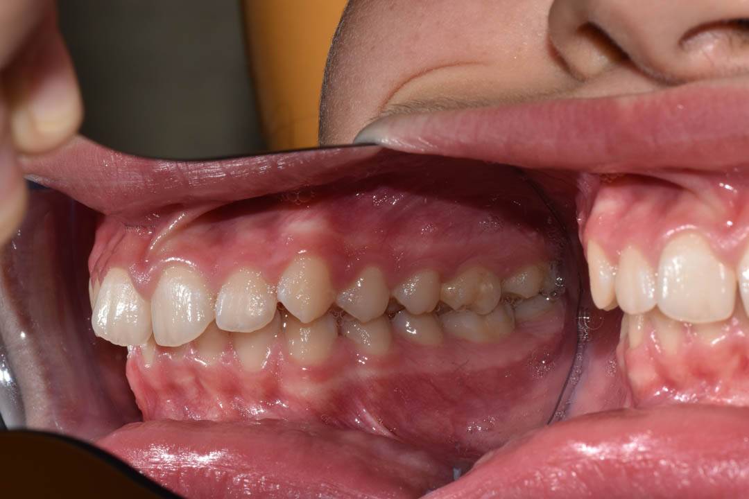 odontocentro-monza-brianza-ortodonzia-fissa- ( (3)
