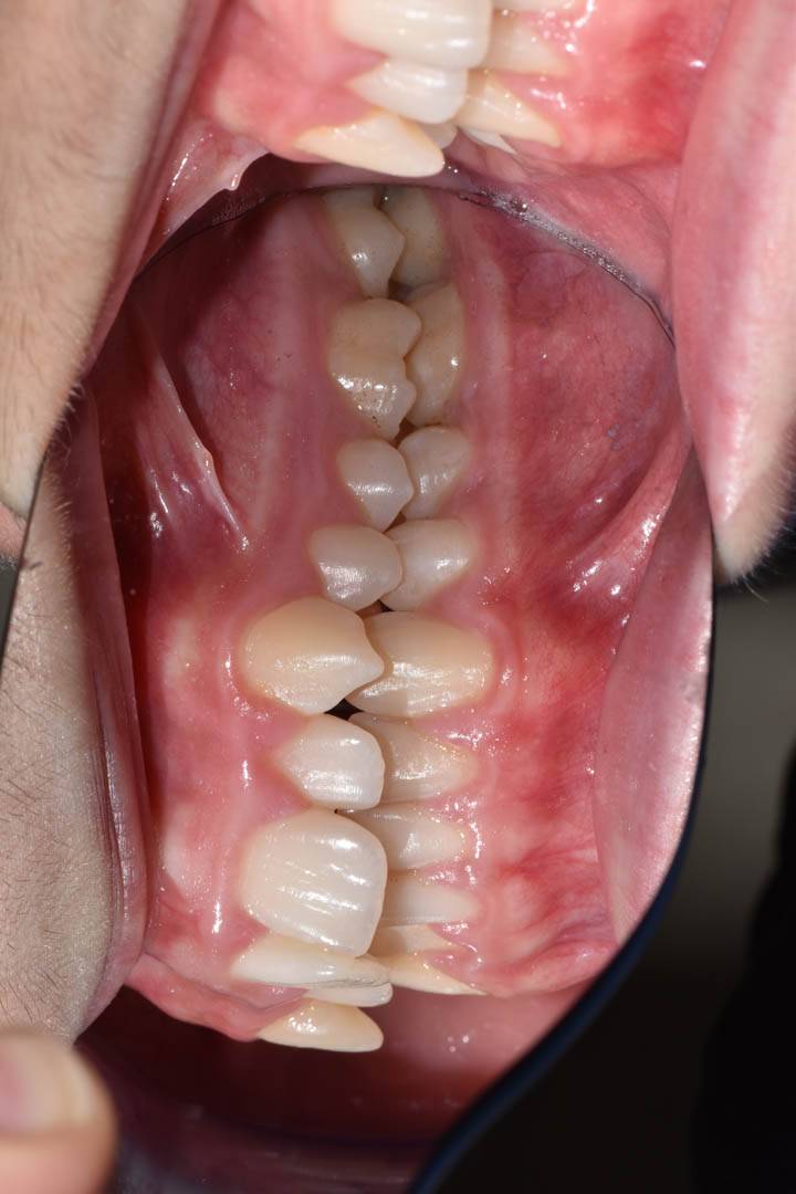 odontocentro-monza-brianza-casi-clinici-ortodonzia-fissa-20-mesi (5)