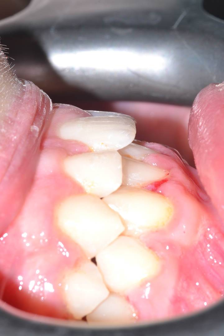 odontocentro-monza-brianza-casi-clinici-ortodonzia-bimascellare-20-mesi (8)
