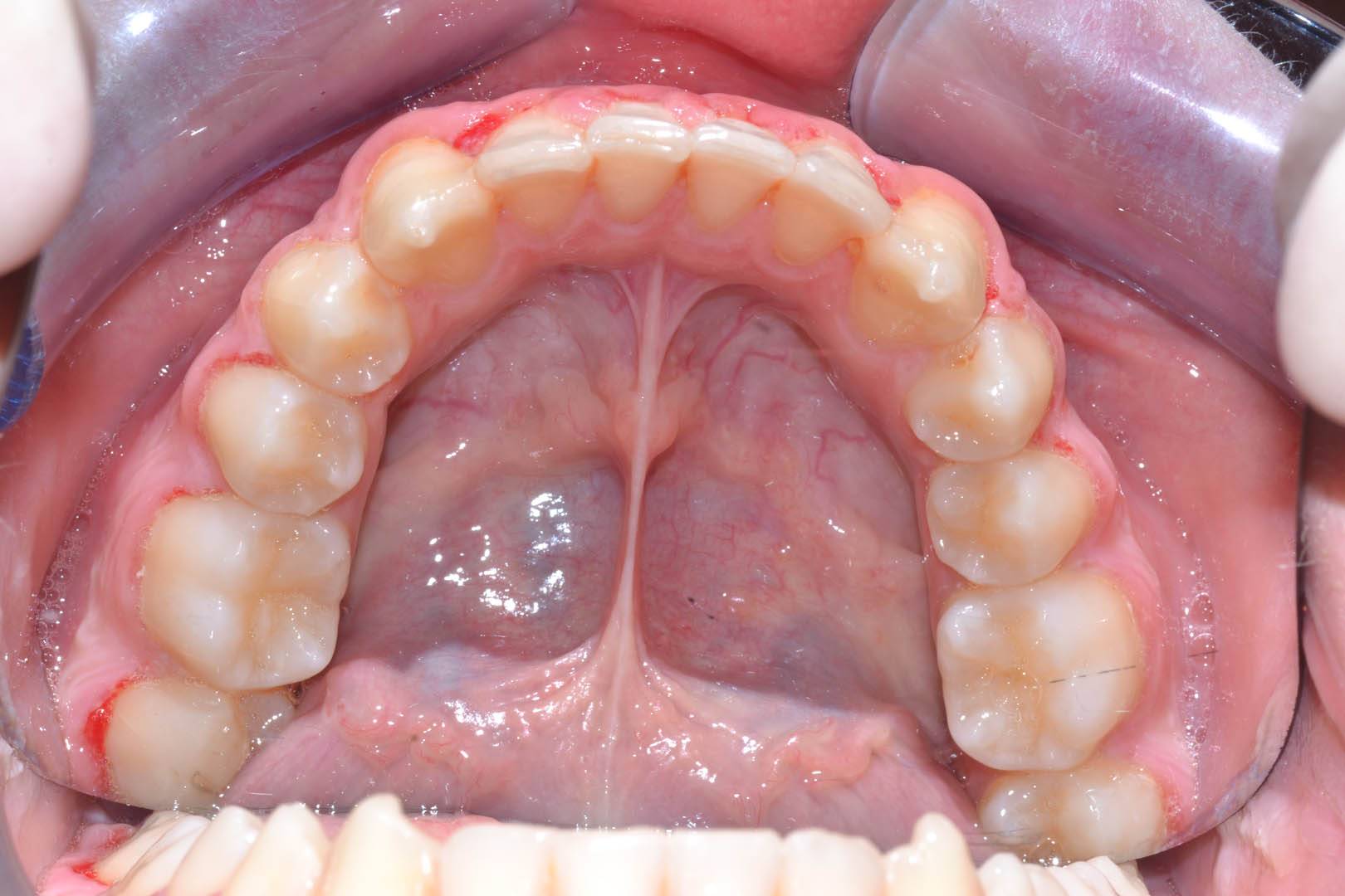 odontocentro-monza-brianza-casi-clinici-ortodonzia-bimascellare-20-mesi (12)
