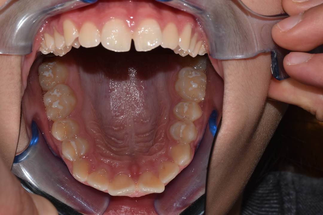 odontocentro-monza-brianza-ortodonzia-fissa- ( (4)