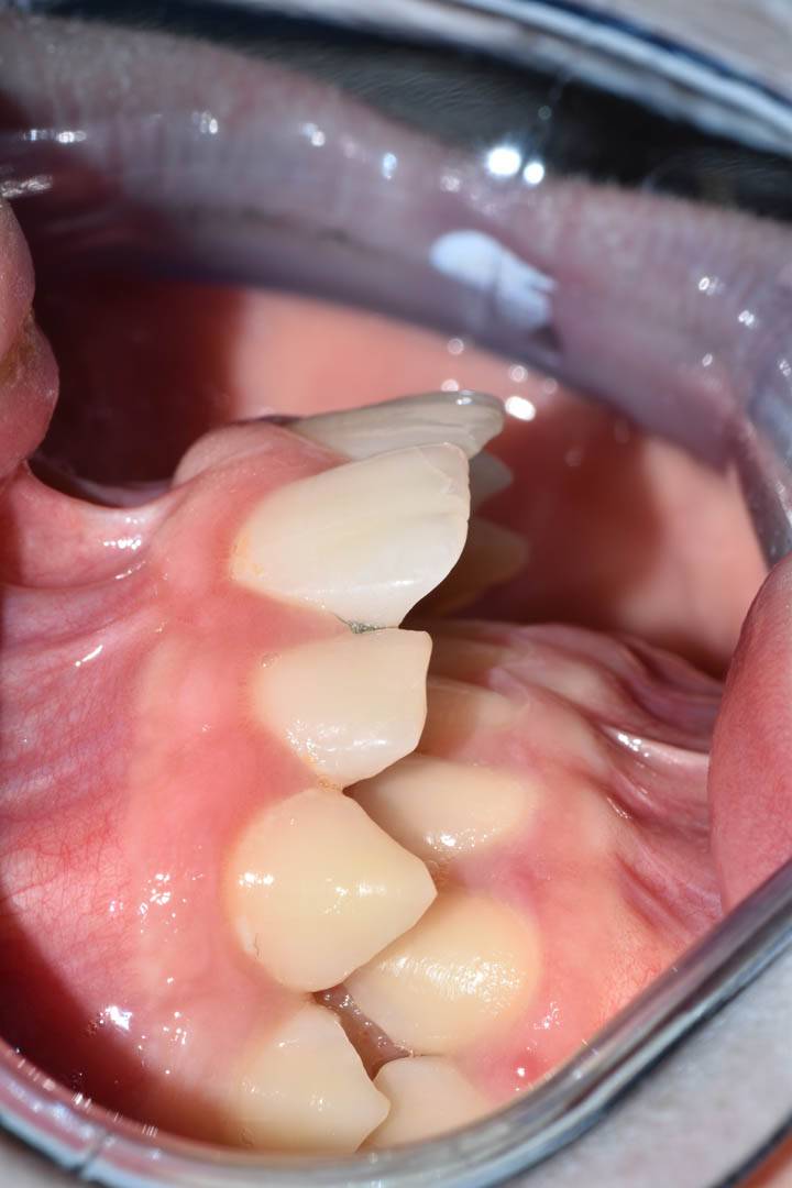 odontocentro-monza-brianza-casi-clinici-ortodonzia-bimascellare-20-mesi (2)