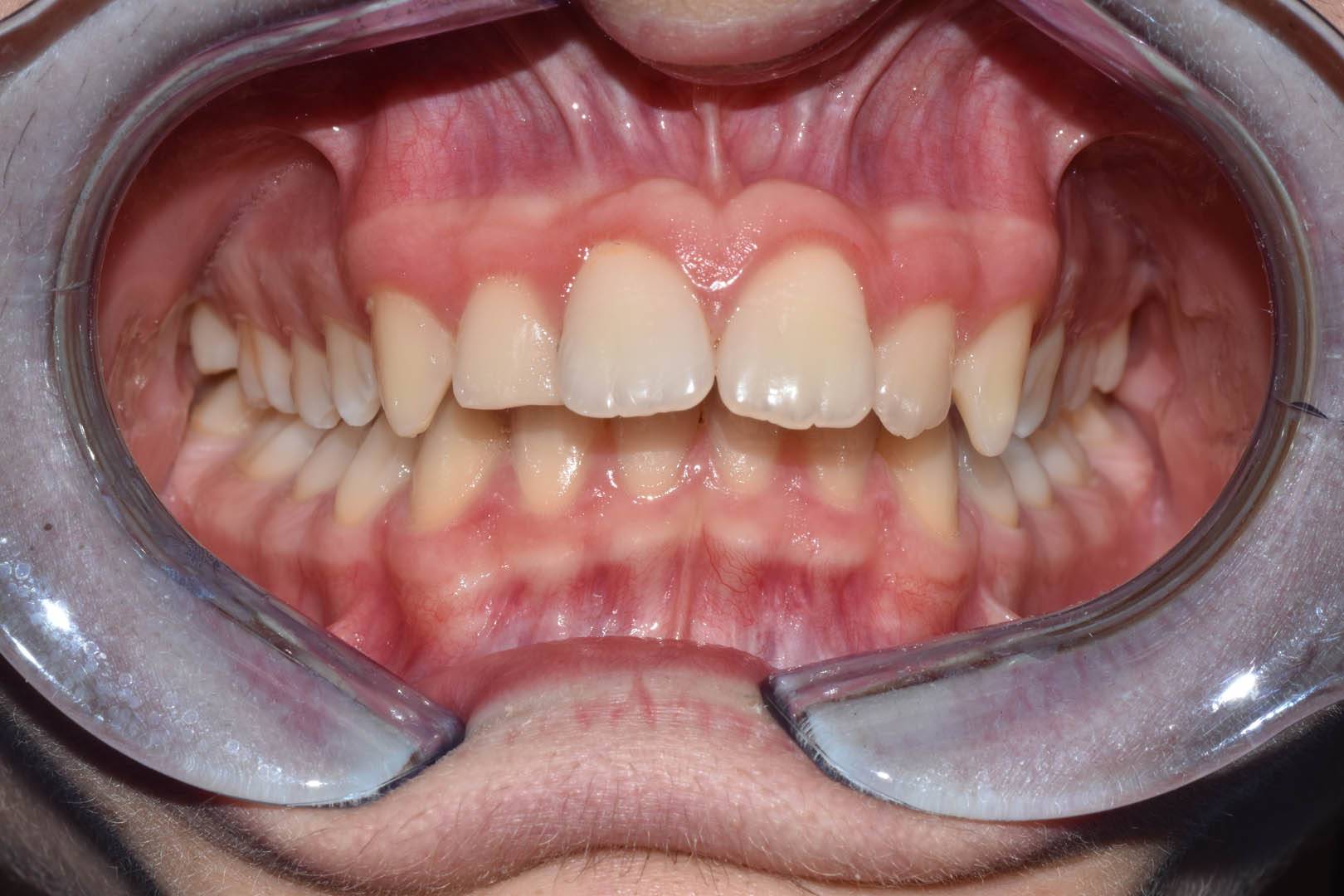 odontocentro-monza-brianza-casi-clinici-ortodonzia-bimascellare-20-mesi (1)