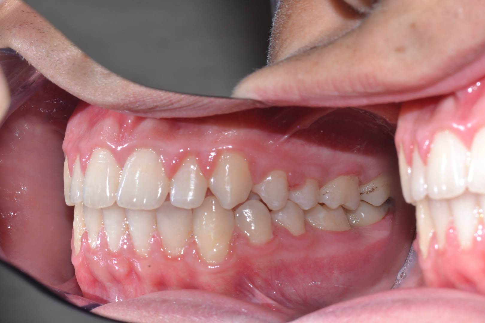 odontocentro-monza-brianza-casi-clinici-ortodonzia-fissa-20-mesi (9)