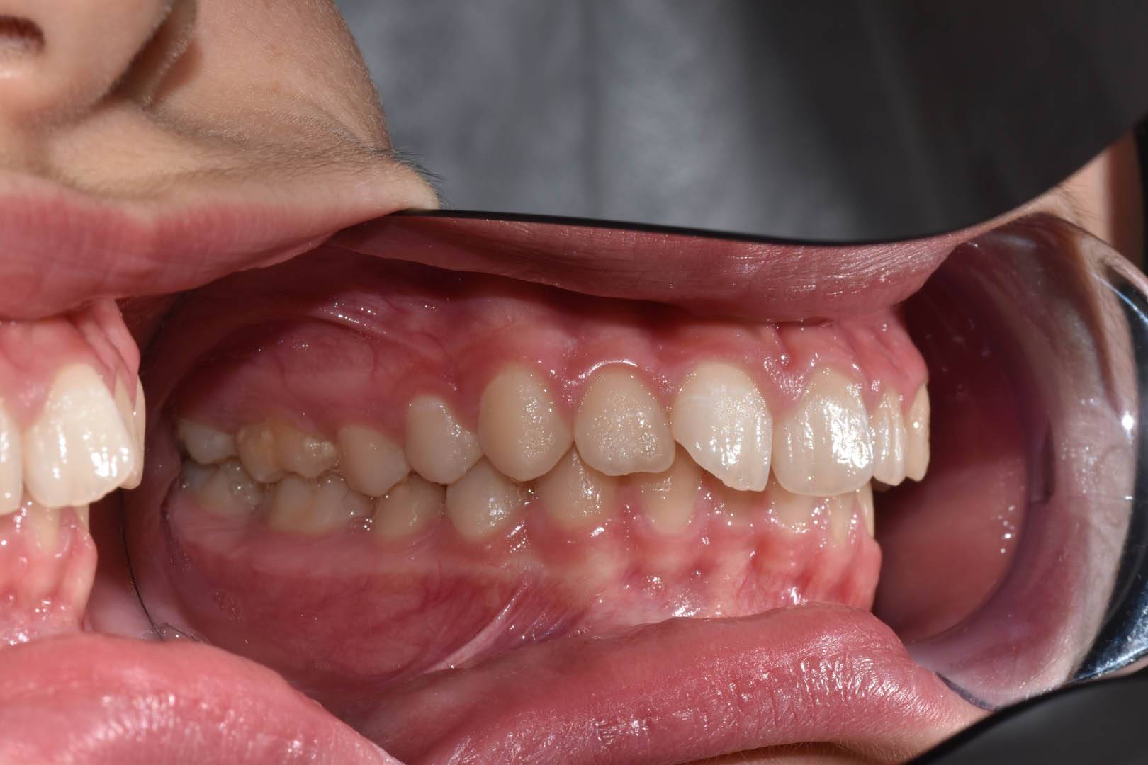 odontocentro-monza-brianza-ortodonzia-fissa- (