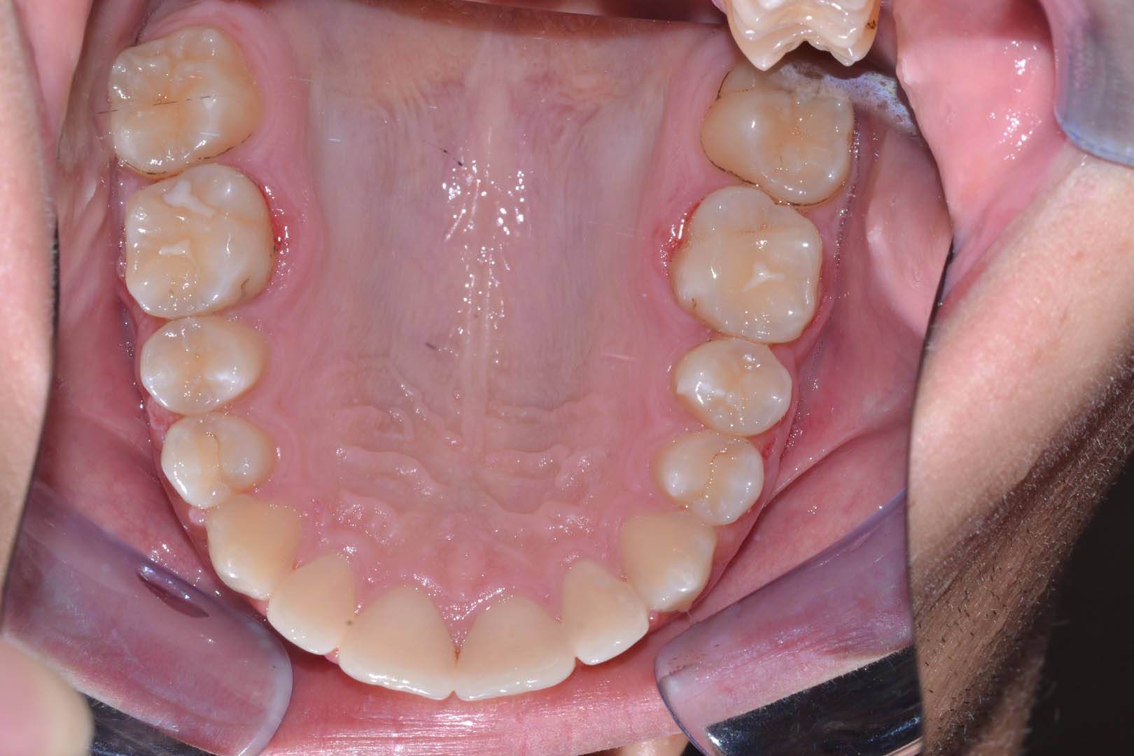 odontocentro-monza-brianza-casi-clinici-ortodonzia-fissa-20-mesi (1)