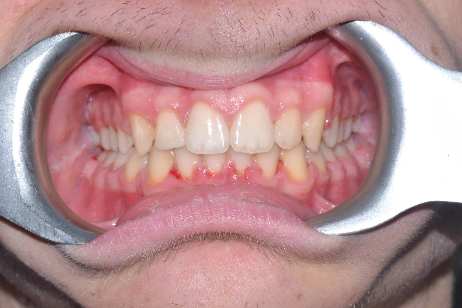 odontocentro-monza-brianza-casi-clinici-ortodonzia-bimascellare-20-mesi (7)