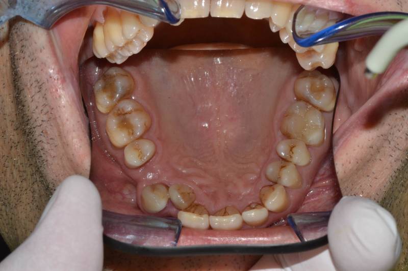 odontocentro-monza-brianza-casi-clinici-apparecchio-invisibile-18-mesi (2)