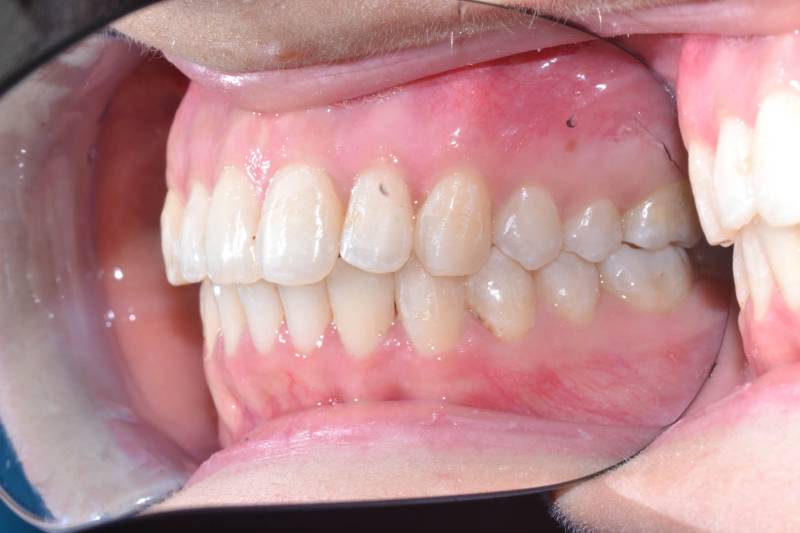 odontocentro-monza-brianza-casi-clinici-apparecchio-invisibile16-mesi (7)