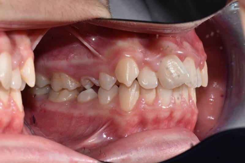 odontocentro-monza-brianza-casi-clinici-ortodonzia-fissa-20-mesi (4)