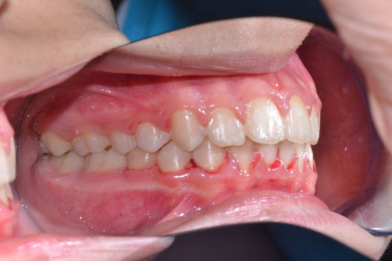 odontocentro-monza-brianza-ortodonzia-fissa- ( (7)