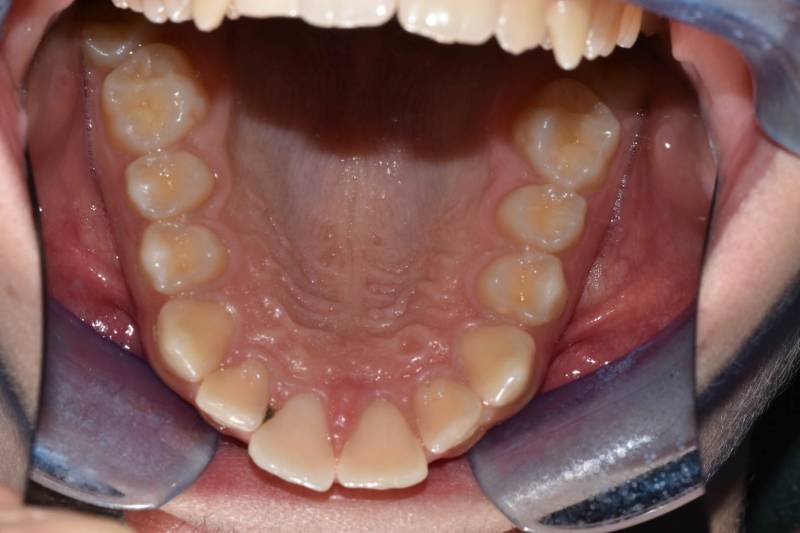 odontocentro-monza-brianza-casi-clinici-ortodonzia-bimascellare-20-mesi (5)